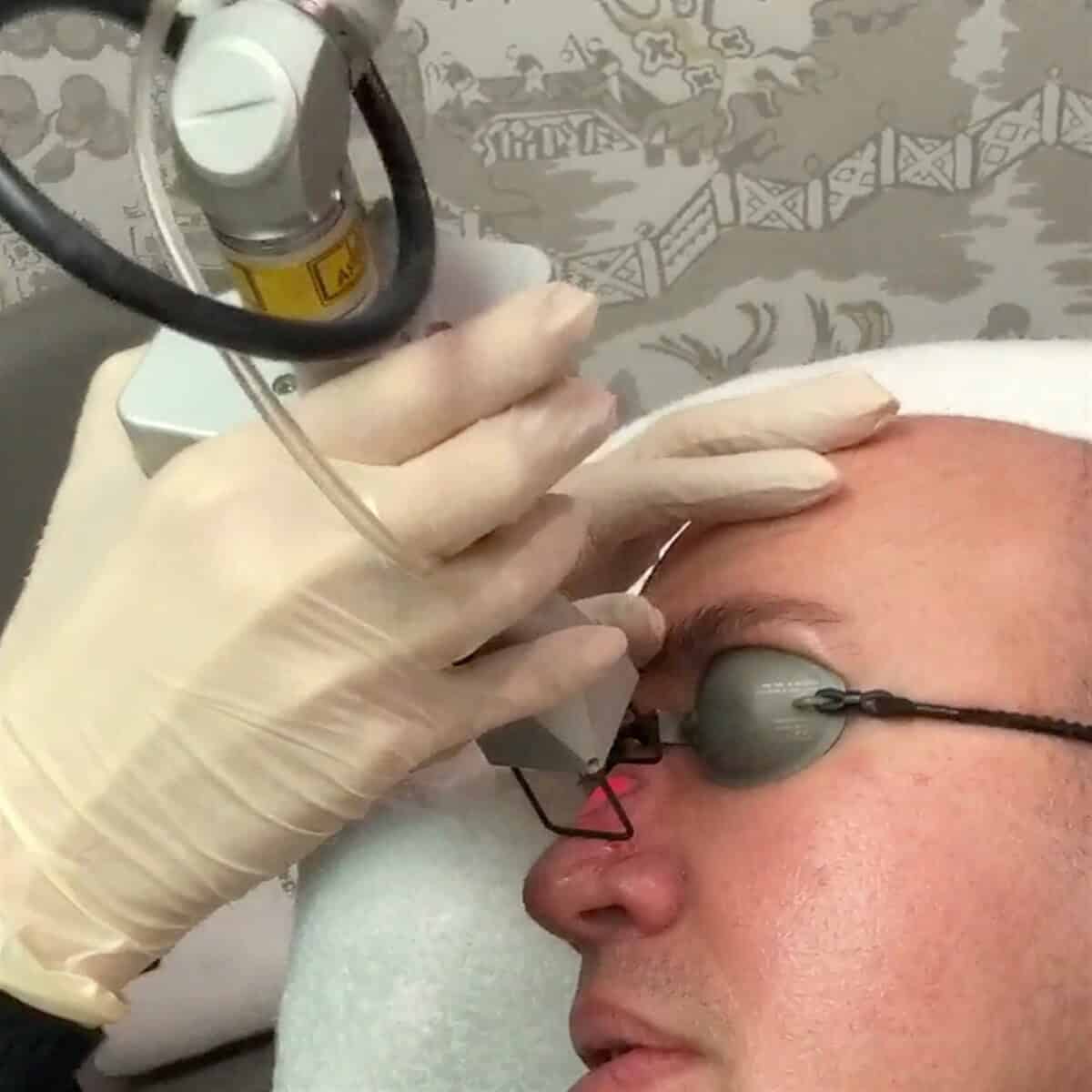 CO2 Laser
