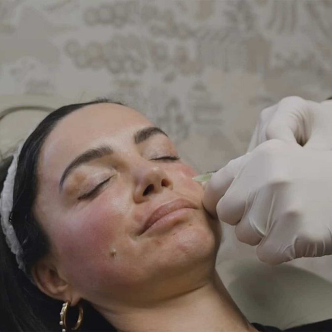 PRP Facial