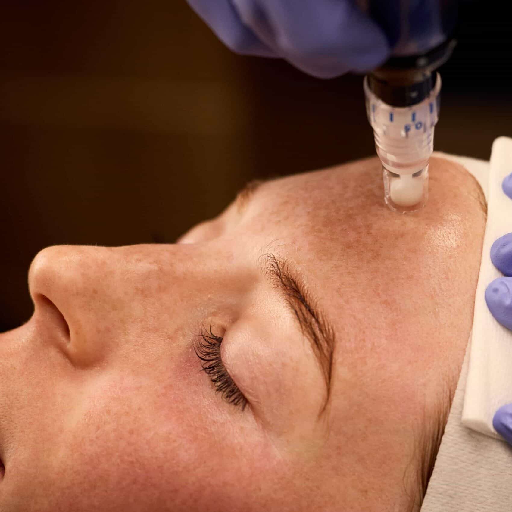 Microneedling