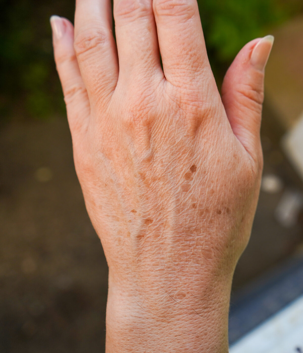 Spots on the Backs of Your Hands