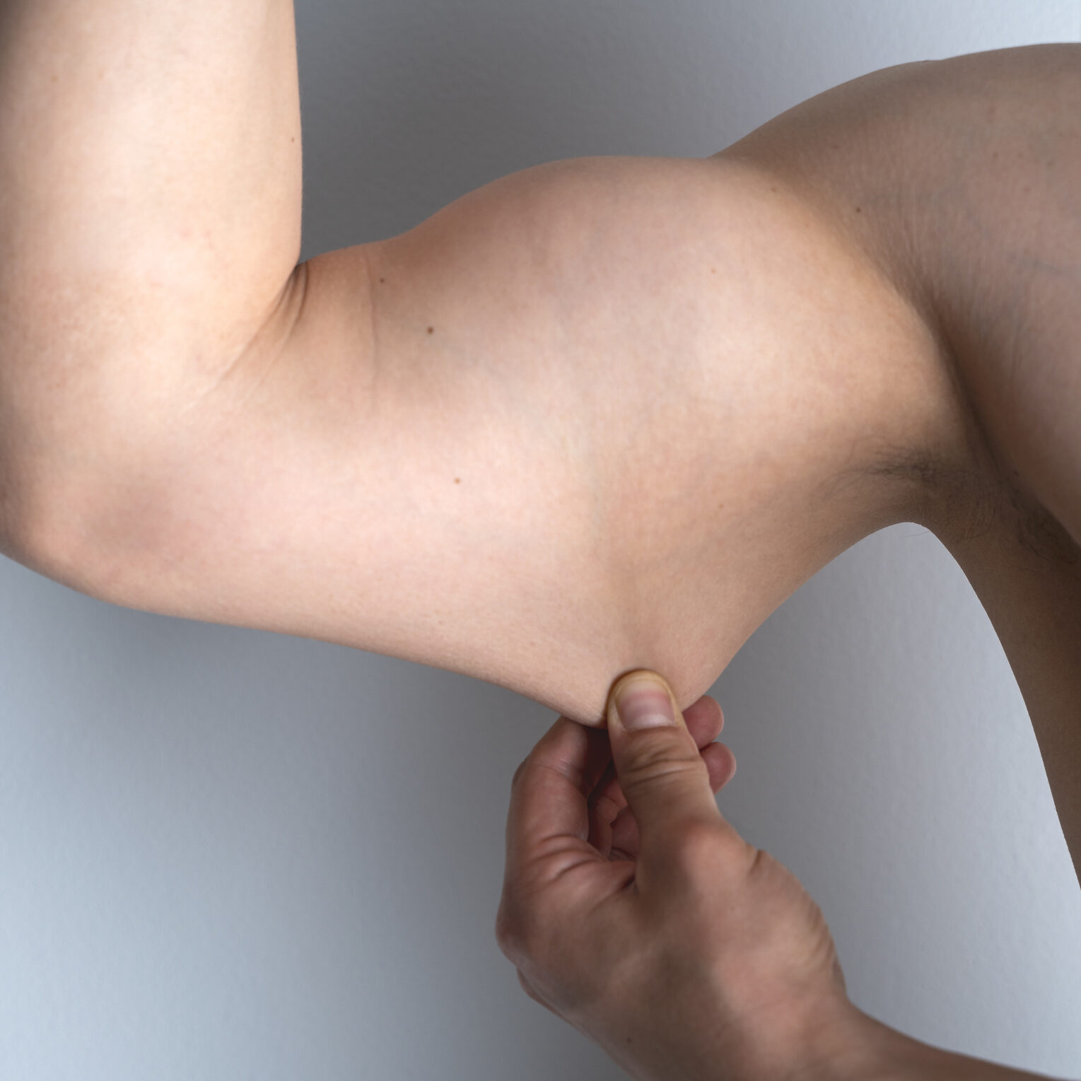 Arms After Weight Loss