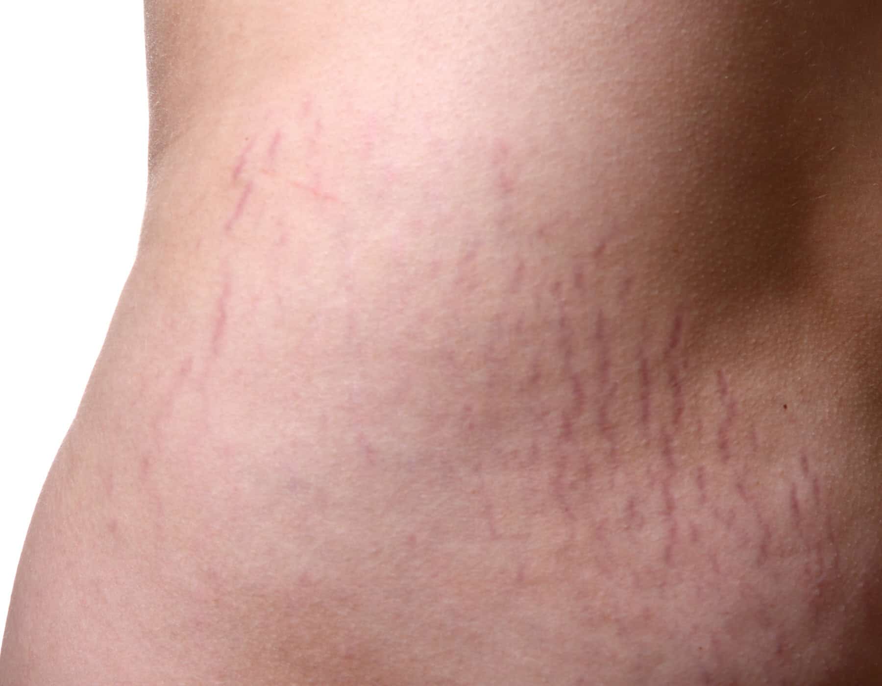Fresh Red or Purple Marks