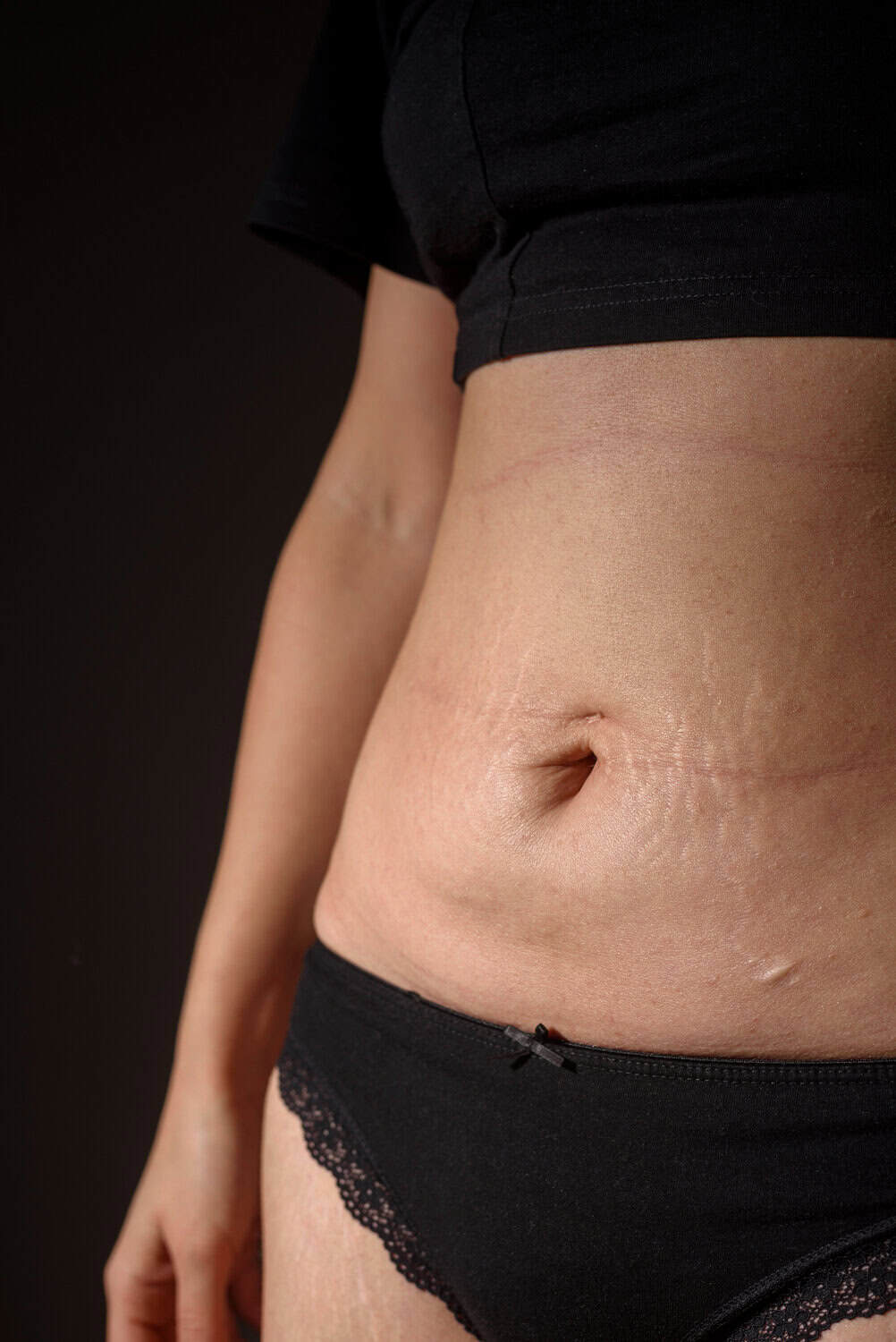 Post Pregnancy Marks
