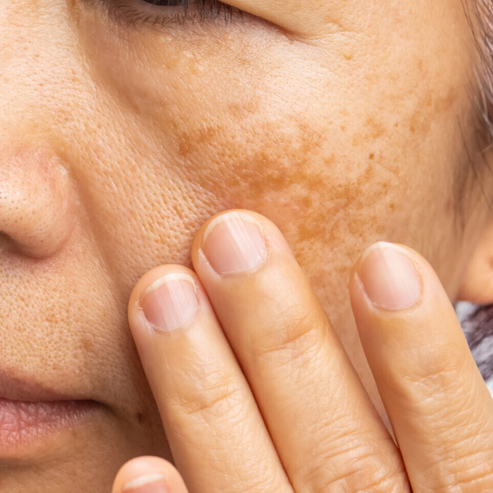Melasma