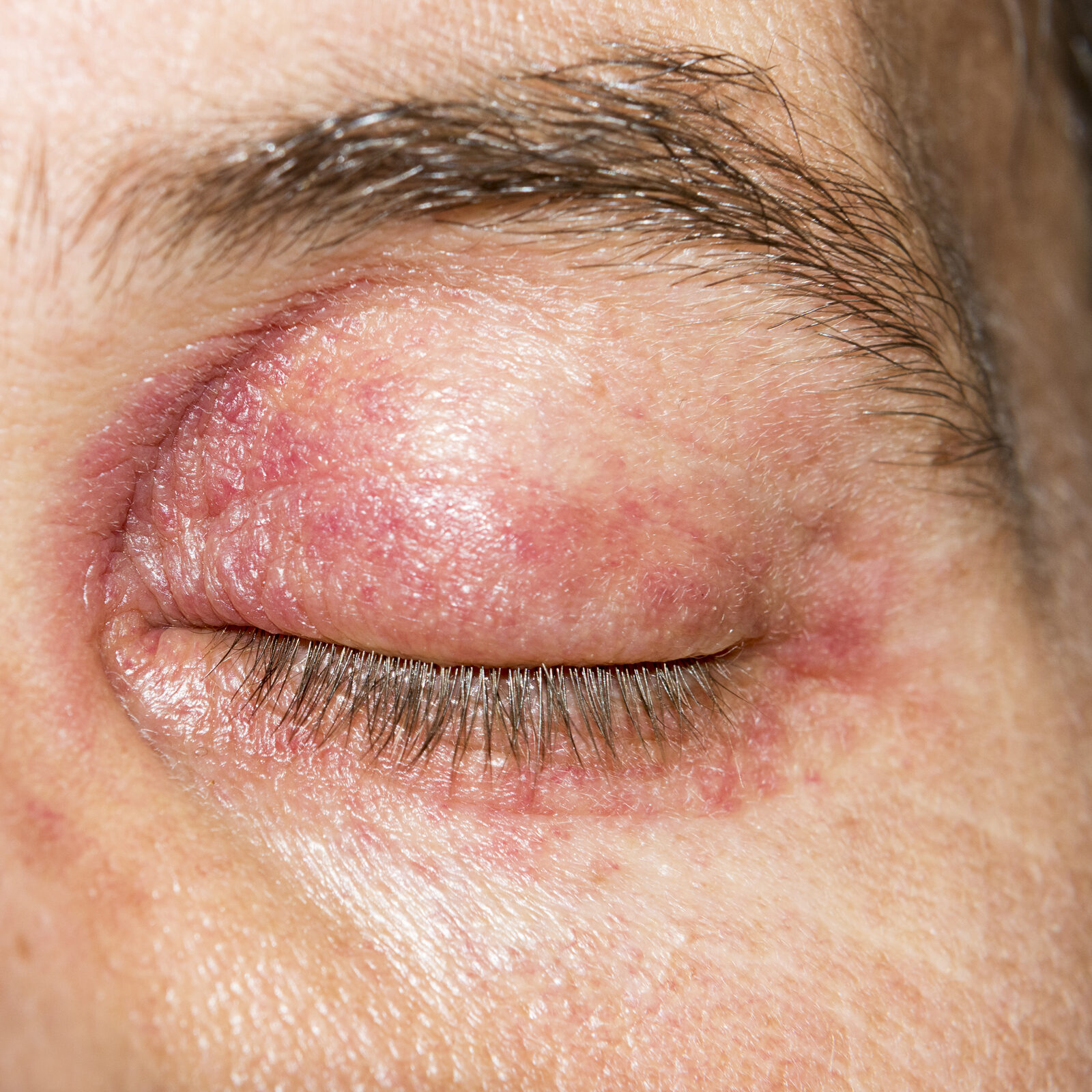 Sore Eyes or a Thickening Nose