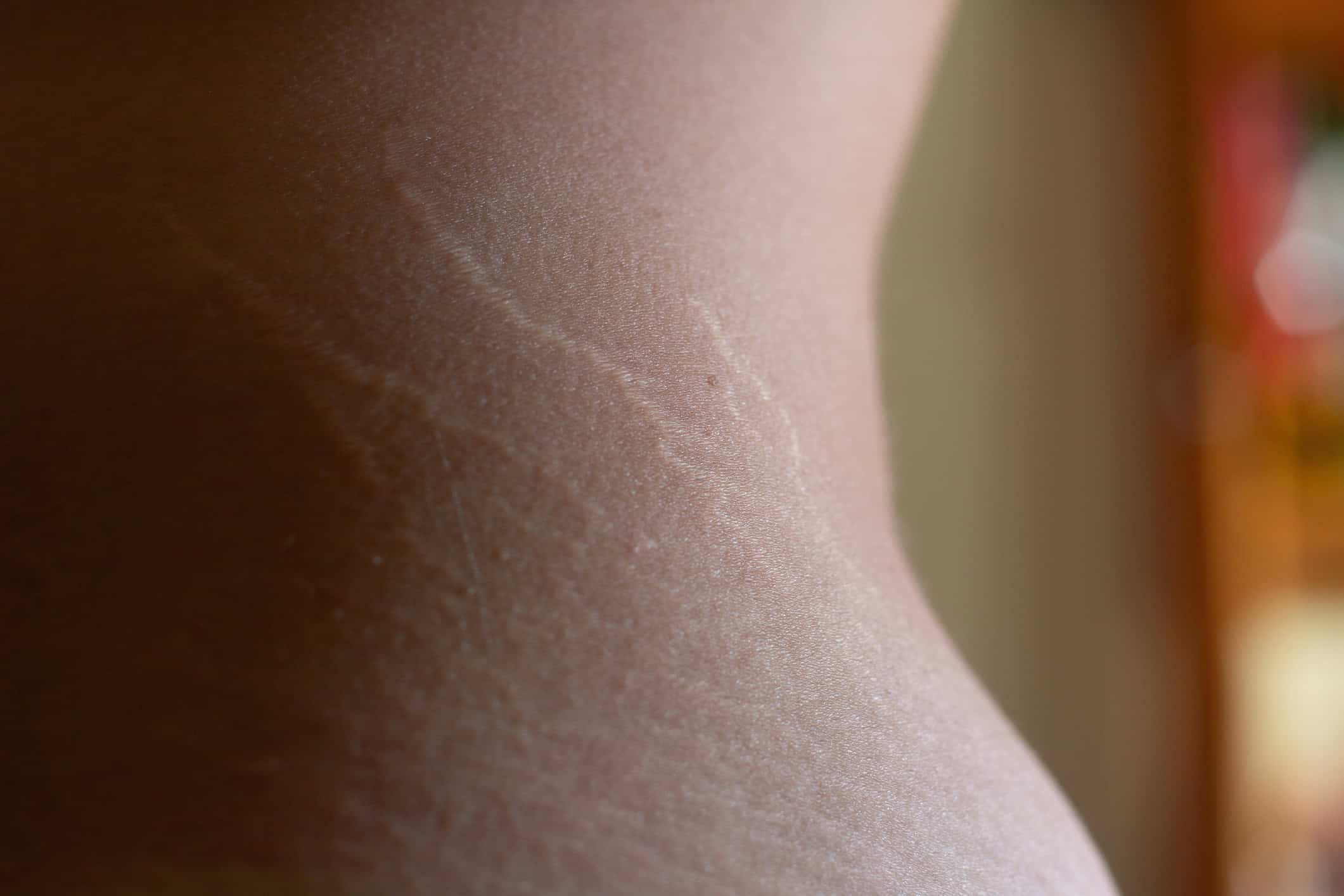 Older Silvery White Marks