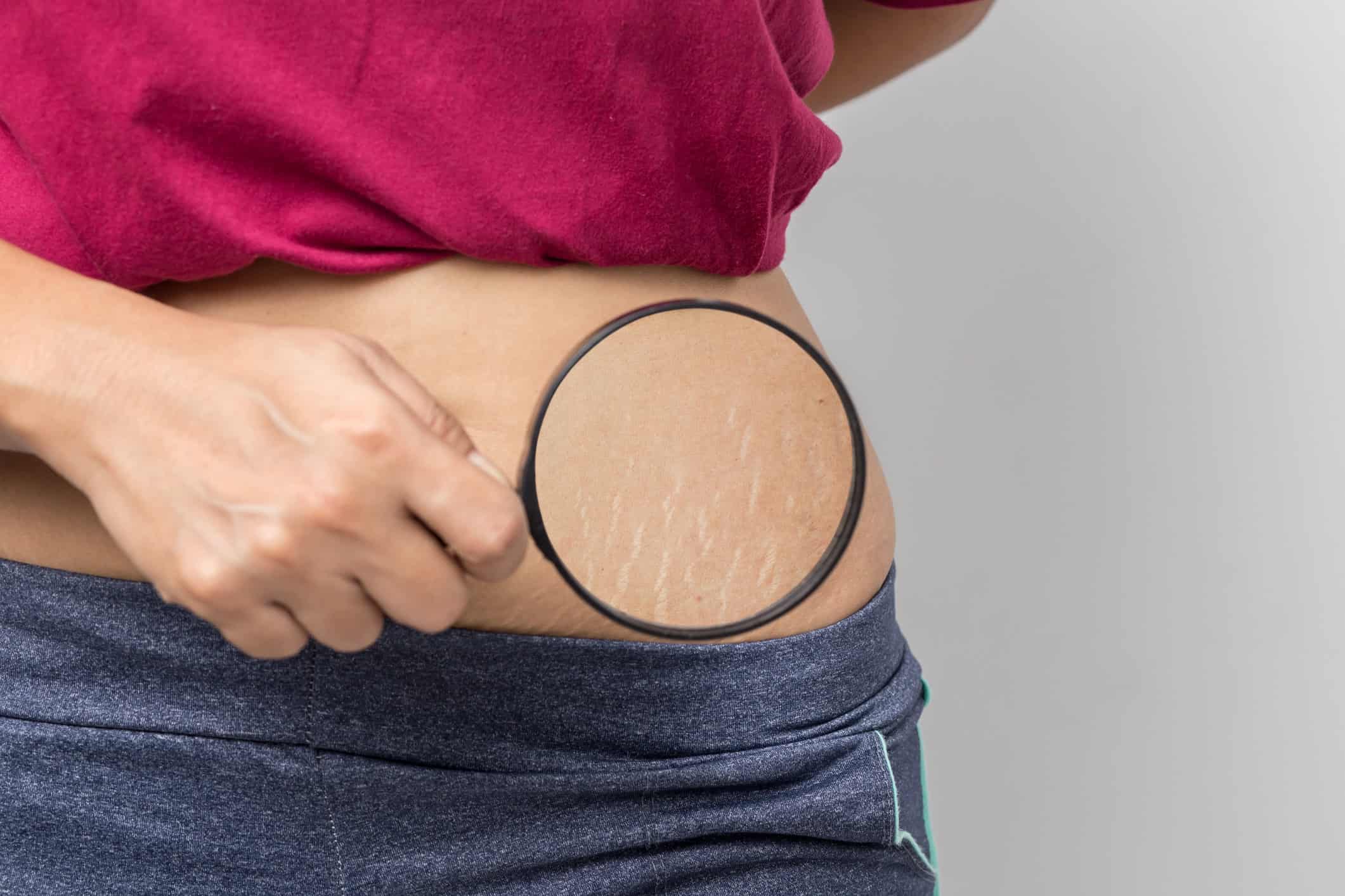 Stretch Mark Programme