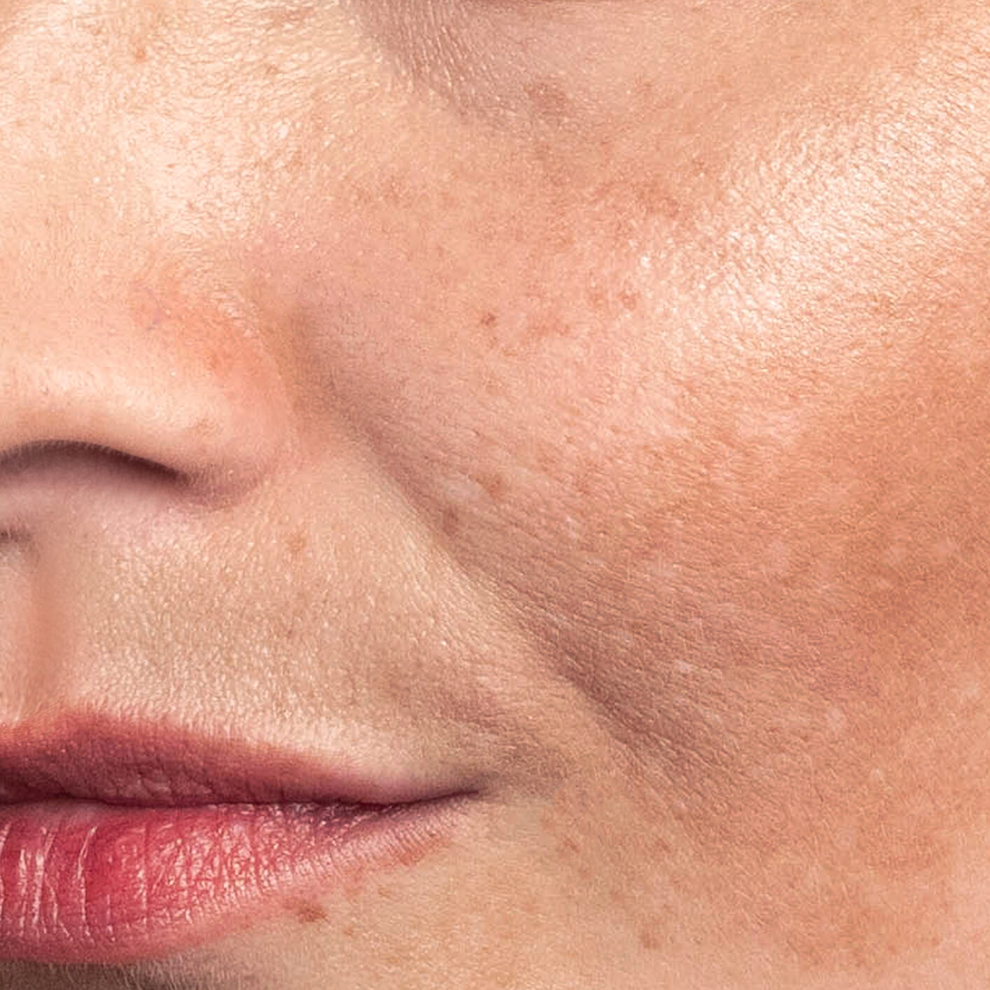 Sun Spots and Age Spots